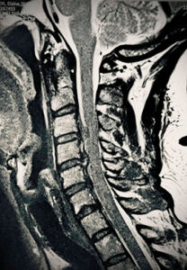 MRI showing cervical disc prolapse with cord compression